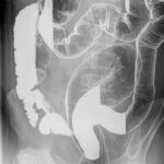 Barium enema with contrast
